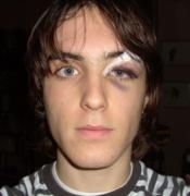 Small skiing accident...